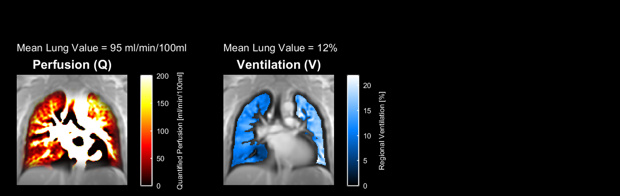 Ventilation and Perfusion Maps